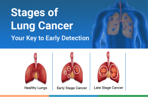 Stages of Lung Cancer: Your Key to Early Detection